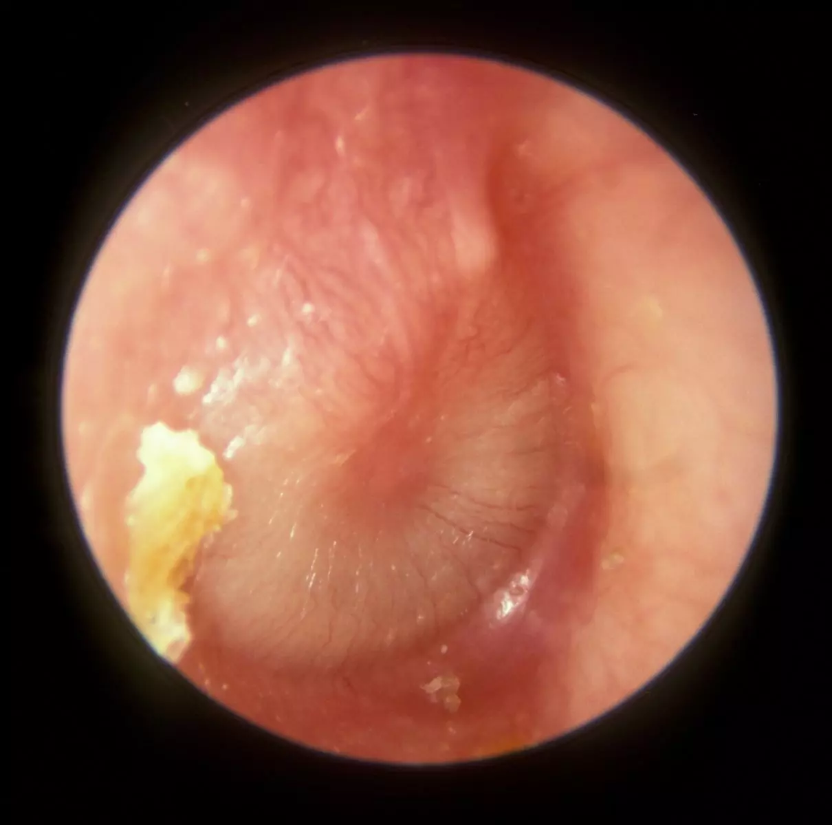 Acute Otitis Media SimpleMed