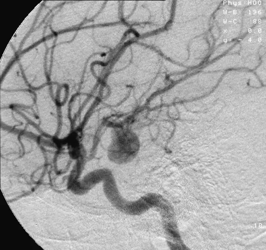 Aneurysm on a Cerebral Angiogram SimpleMed