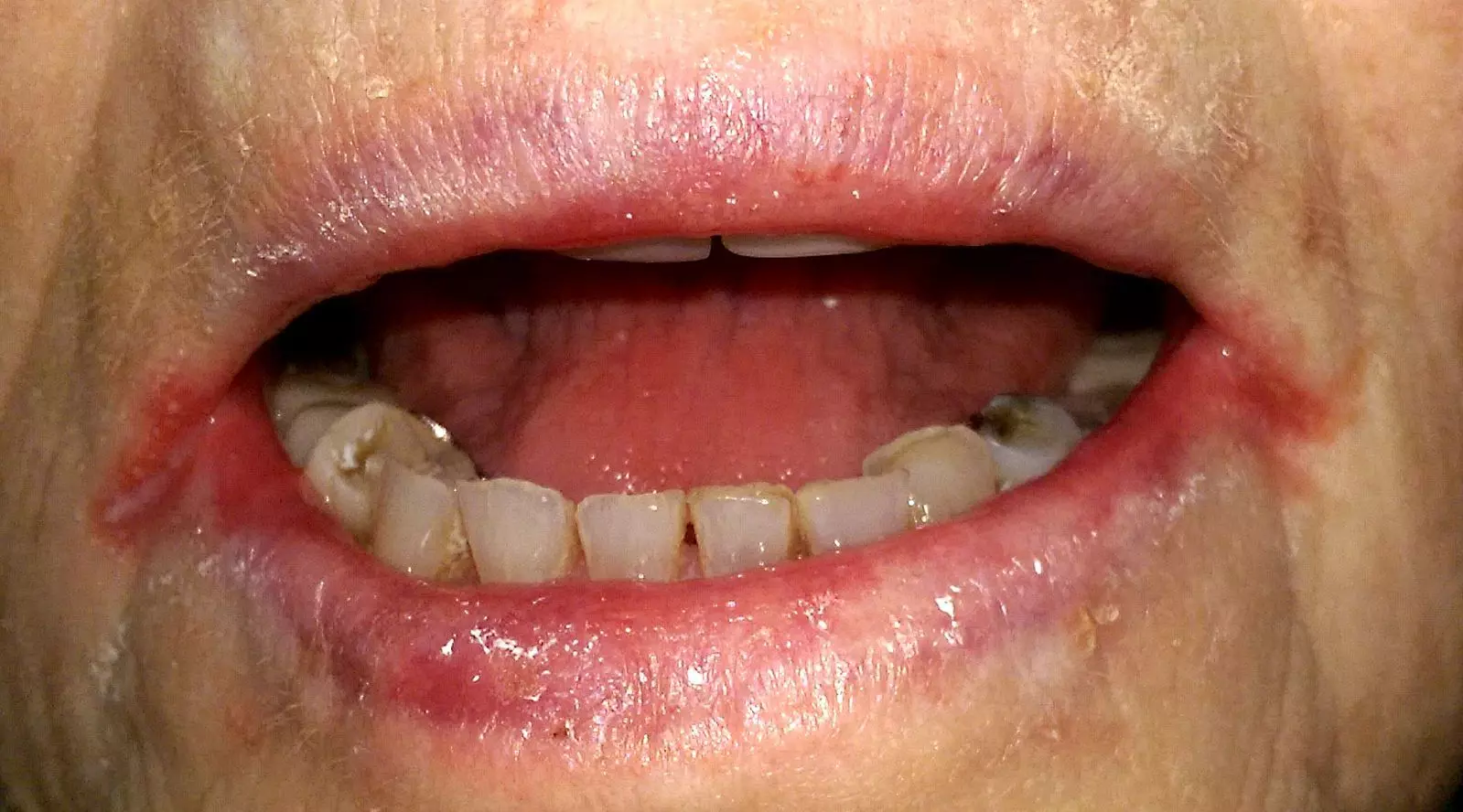 Angular Stomatitis SimpleMed Angular Stomatitis SimpleMed