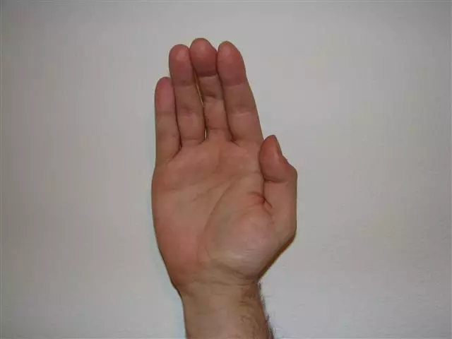 Apehand Deformity SimpleMed