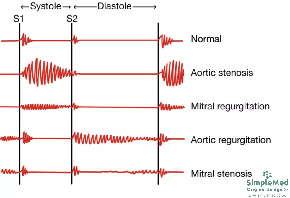 Heart Valve Auscultation Sounds SimpleMed Heart Valve Auscultation Sounds SimpleMed