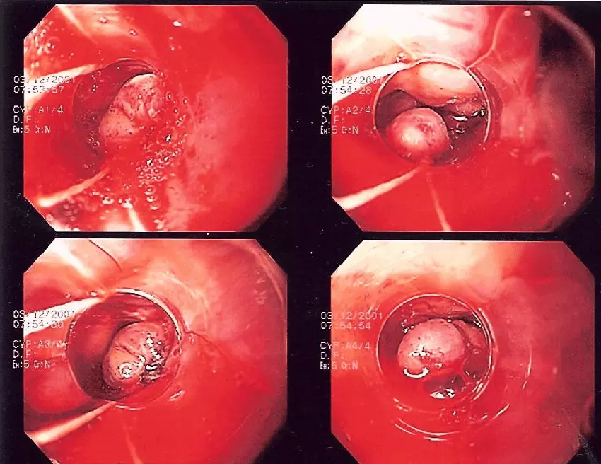 Band Ligation of Oesophageal Varices SimpleMed Band Ligation of Oesophageal Varices SimpleMed
