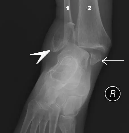 Bimalleolar Fracture X-Ray Medial and Radial Malleolus Fractures SimpleMed Bimalleolar Fracture X-Ray Medial and Lateral Malleolus Fractures SimpleMed