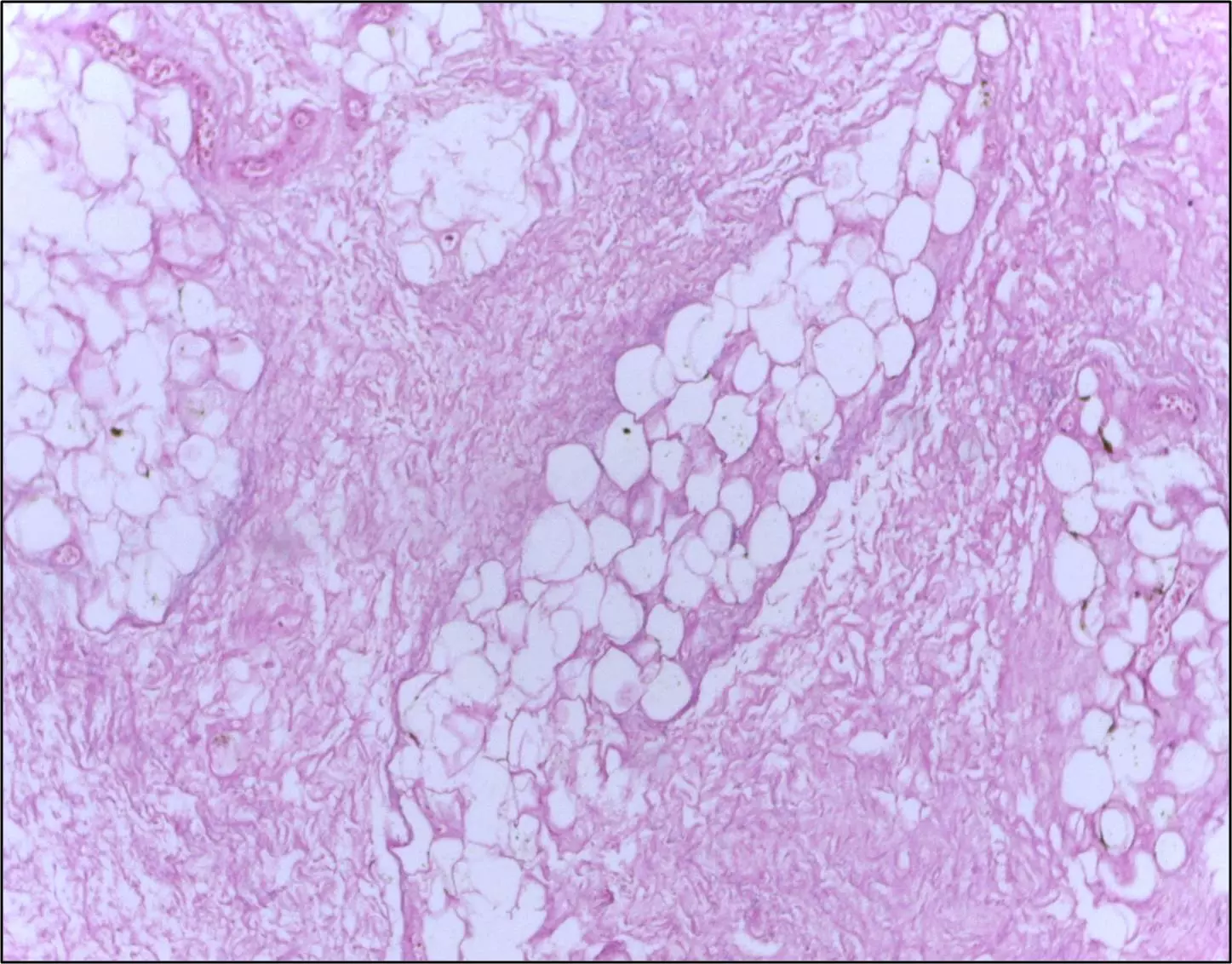 Fat Necrosis of Breast Tissue SimpleMed Fat Necrosis of Breast Tissue SimpleMed