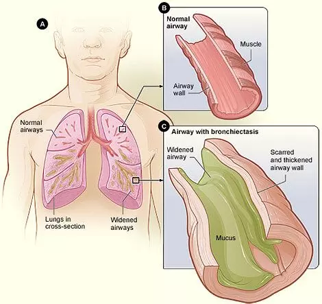 Bronchiectasis vs Normal Lung SimpleMed Bronchiectasis vs Normal Lung SimpleMed