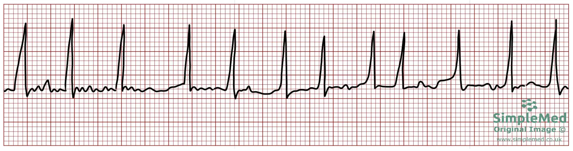 Atrial Fibrillation Electrocardiogram ECG SimpleMed
