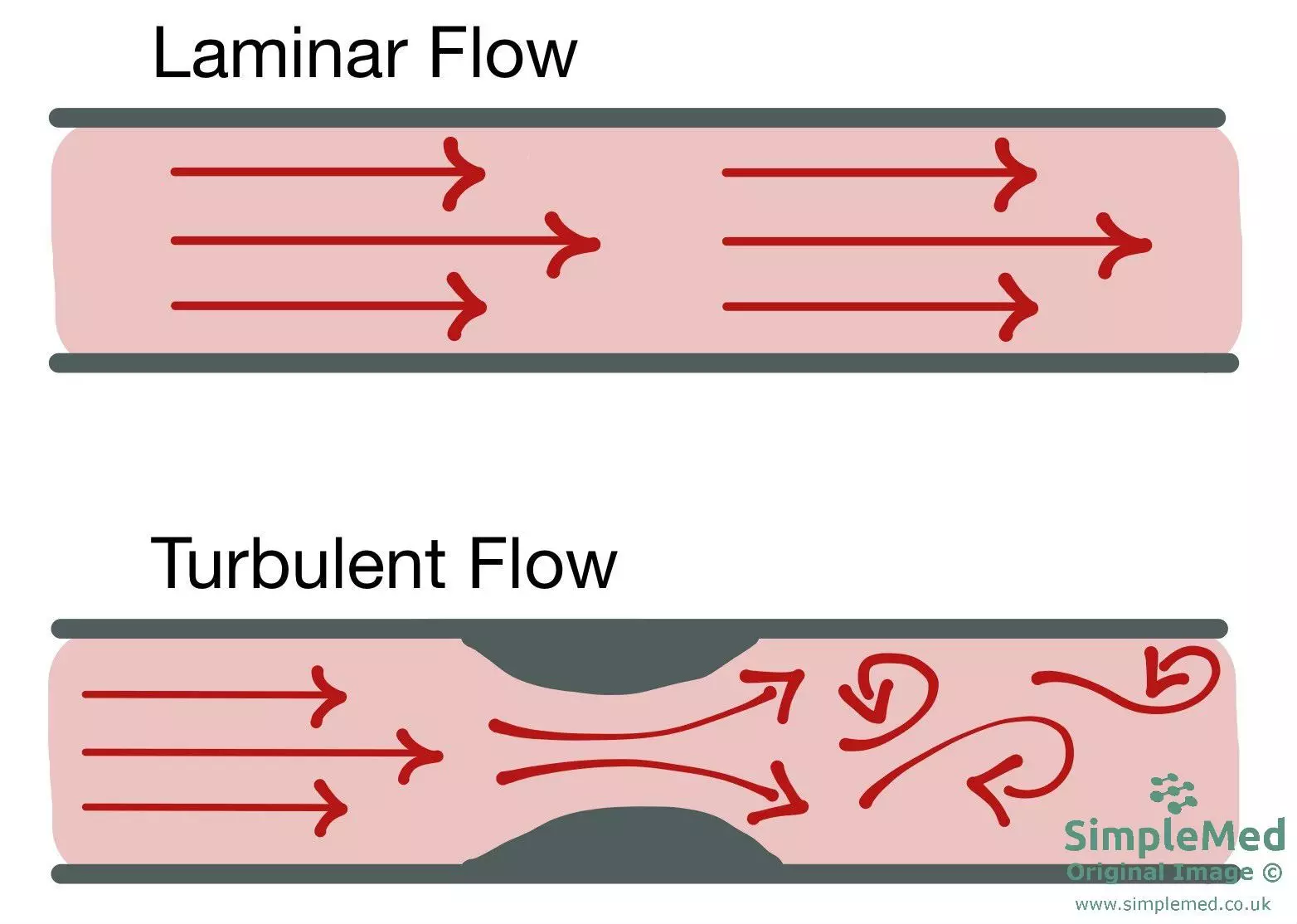 Blood flow in blood vessels - Laminar and Turbulent flow SimpleMed Blood flow in blood vessels - Laminar and Turbulent flow SimpleMed