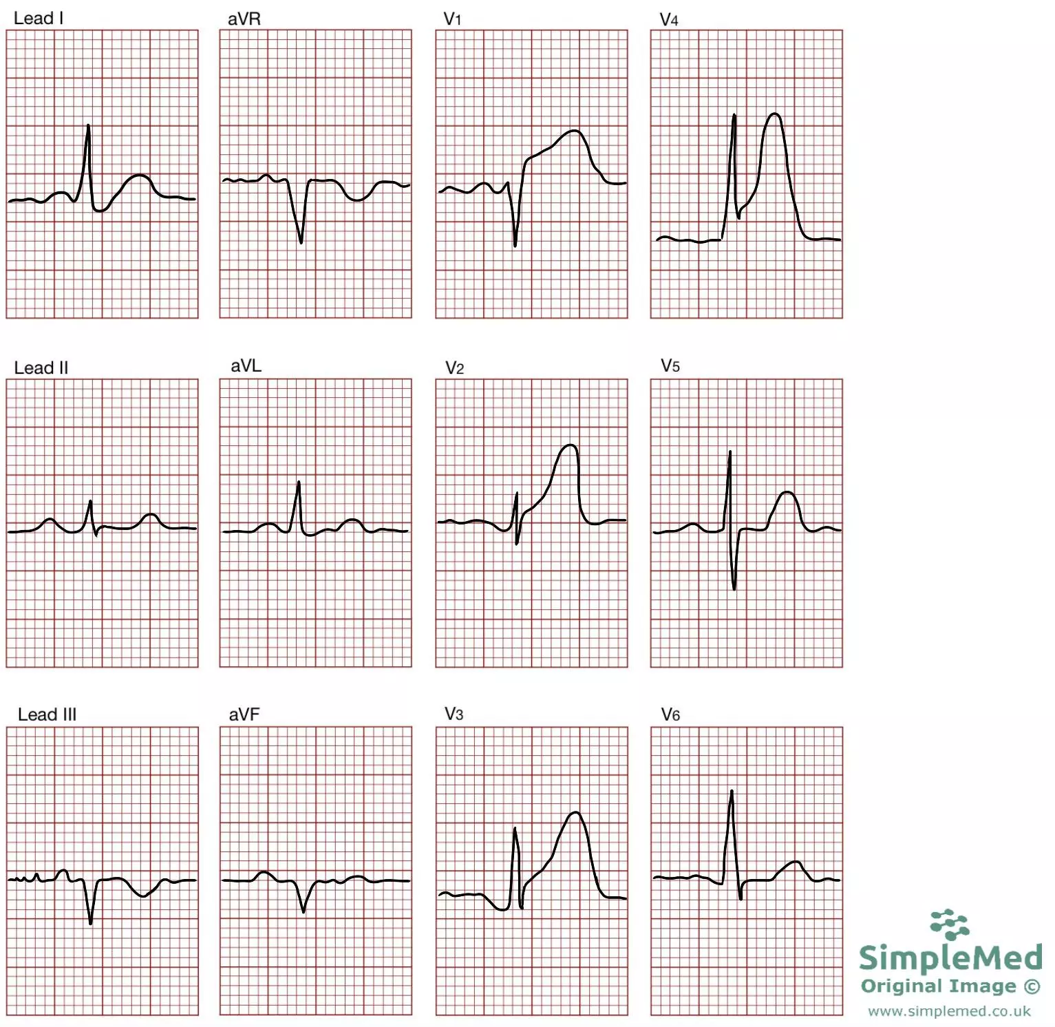 12 Lead ECG of a STEMI SimpleMed