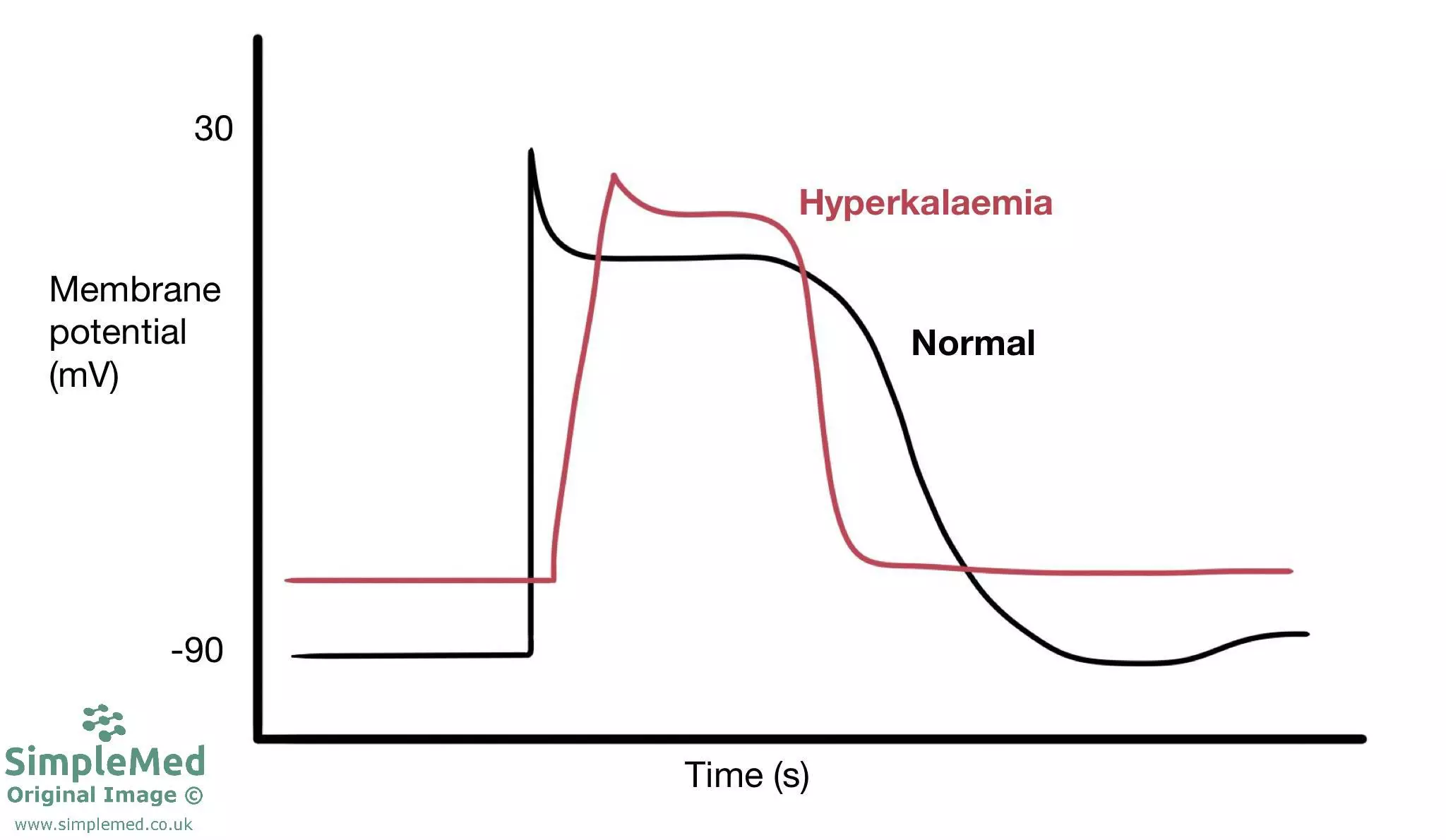 Hyperkalaemia Action Potential SimpleMed Hyperkalaemia Action Potential SimpleMed