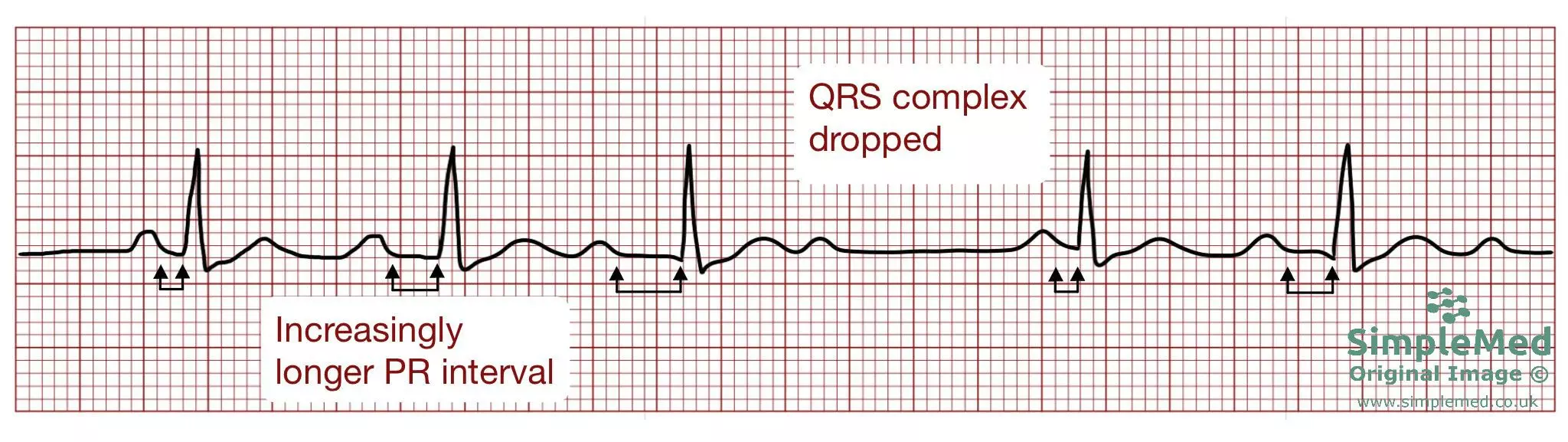 Second degree heart block Mobitz type 1 ECG SimpleMed