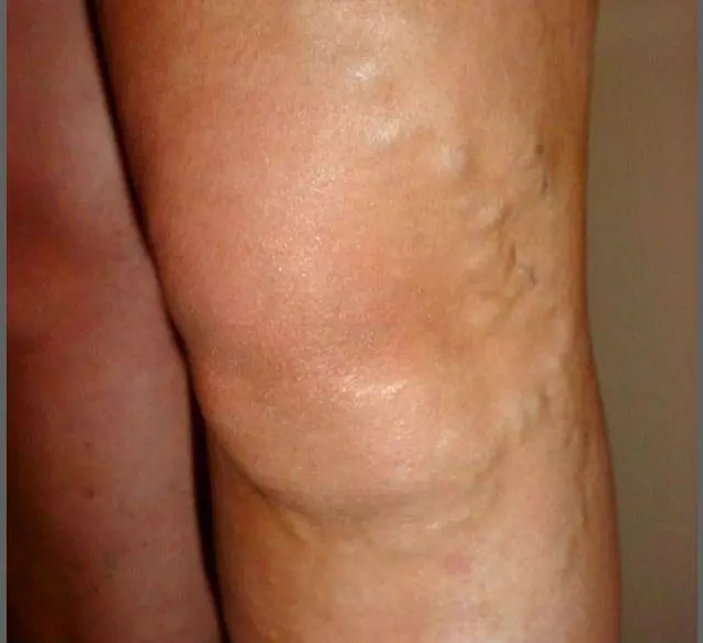 Varicose Veins SimpleMed Varicose Veins SimpleMed
