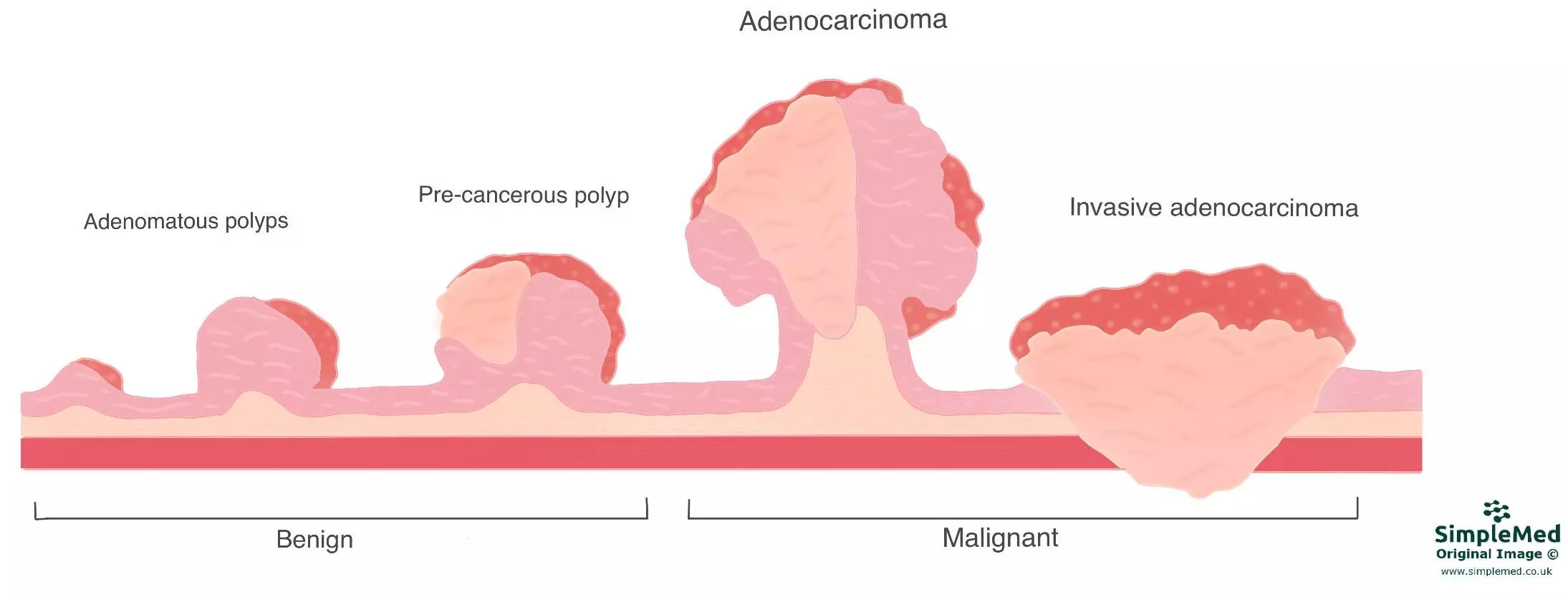 Carcinoma to Adenocarcinoma Progression SimpleMed Carcinoma to Adenocarcinoma Progression SimpleMed