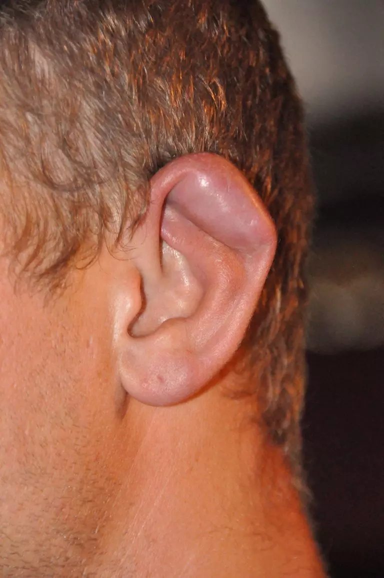 Caulifower Ear Deformity SimpleMed