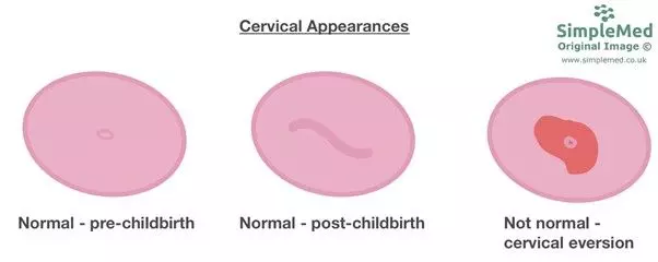 Cervical Appearances SimpleMed Cervical Appearances SimpleMed