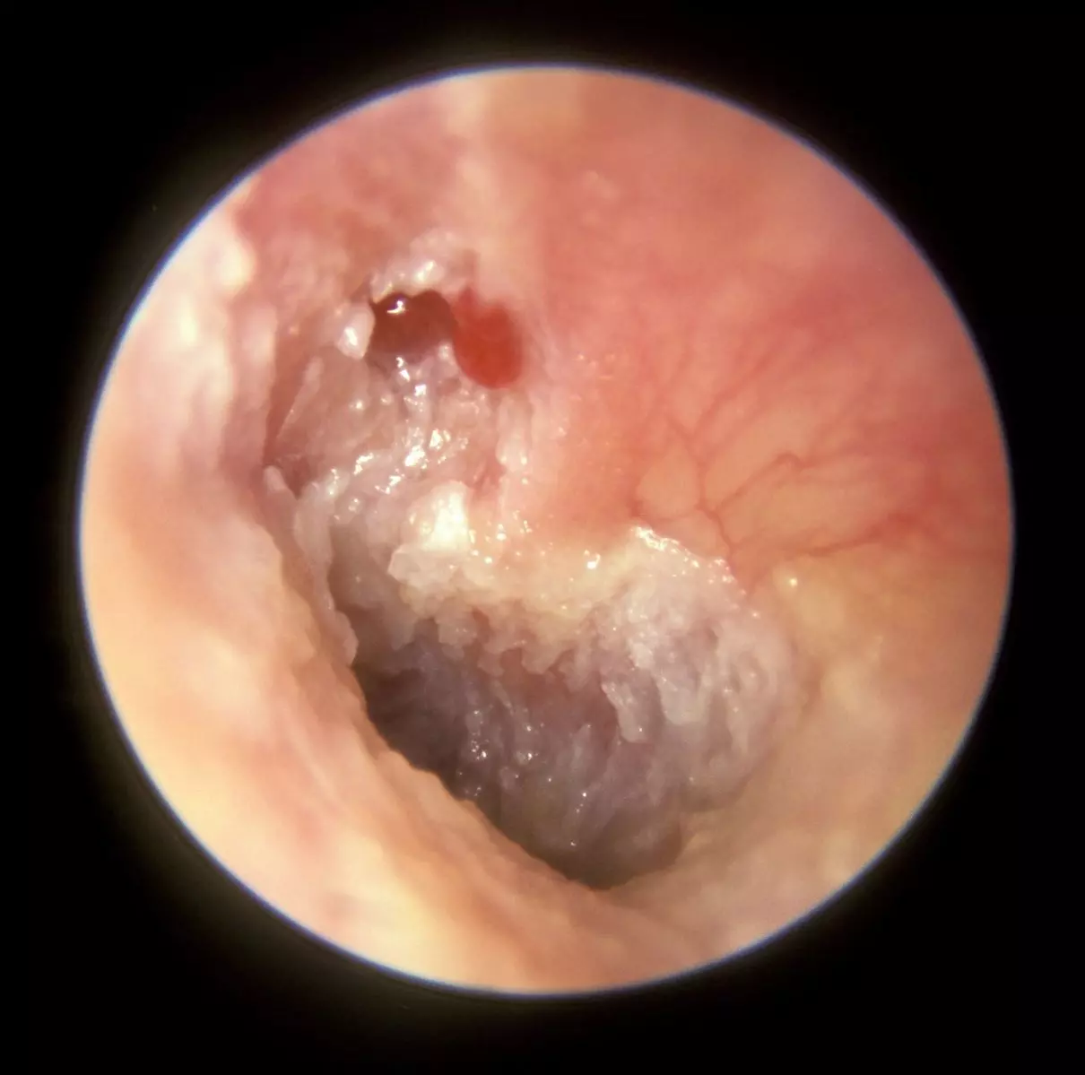 Cholesteatoma SimpleMed