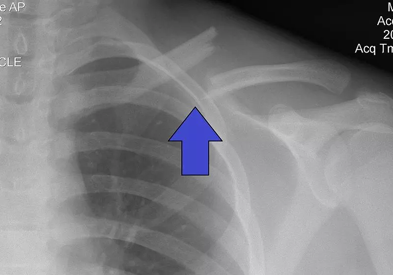 Mid-Clavicular Fracture X-ray SimpleMed