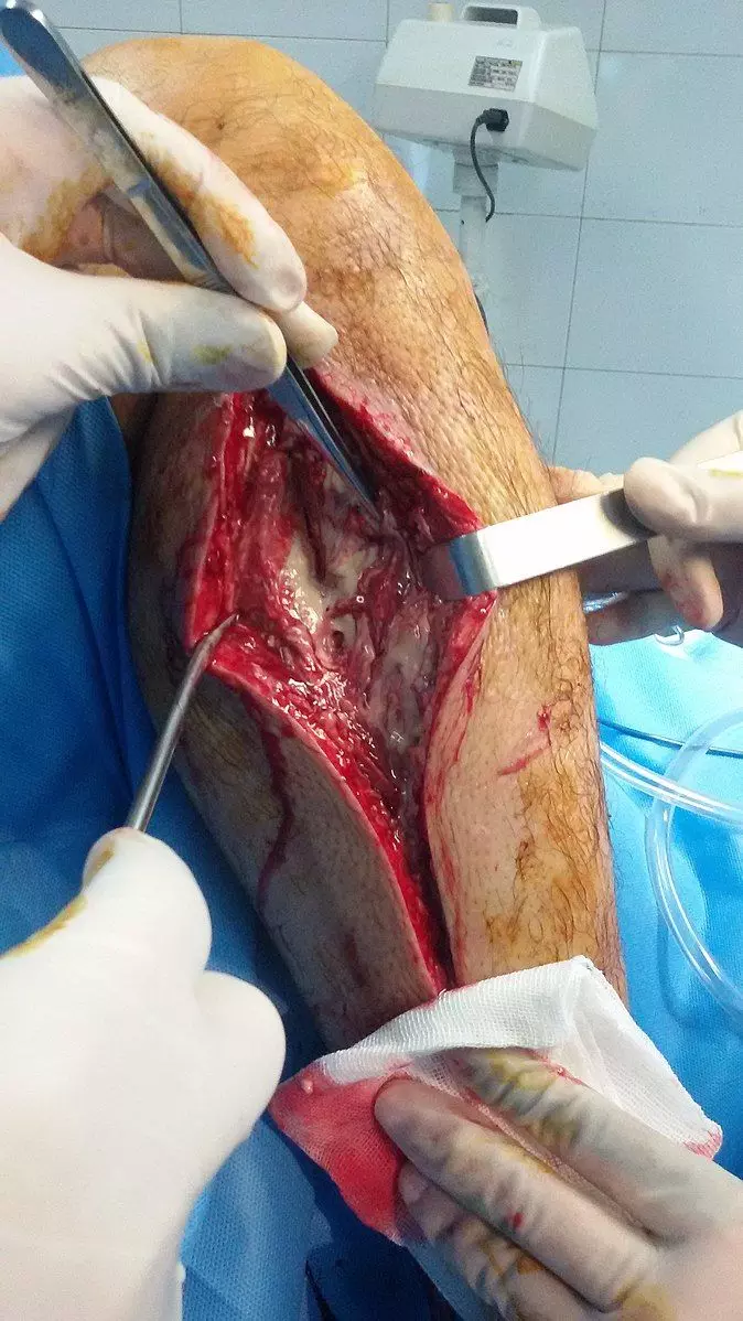 Compartment Syndrome with Fasciotomy Procedure SimpleMed Compartment Syndrome with Fasciotomy Procedure SimpleMed