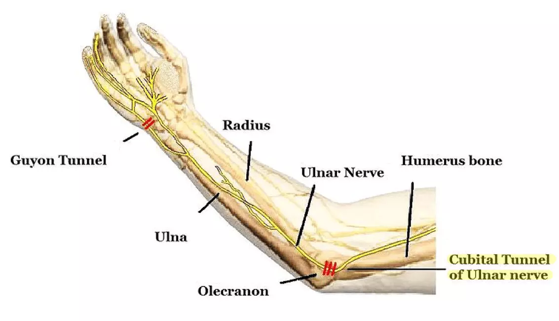 Cubital Tunnel Diagram SimpleMed