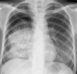 Primary Pulmonary Tuberculosis on Chest X-ray SimpleMed Primary Pulmonary Tuberculosis on Chest X-ray SimpleMed