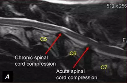 Cervical Myelopathy SimpleMed Cervical Myelopathy SimpleMed
