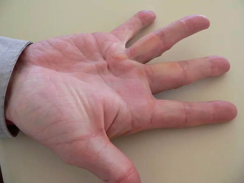 Dupuytren's Contracture SimpleMed Dupuytren's Contracture SimpleMed