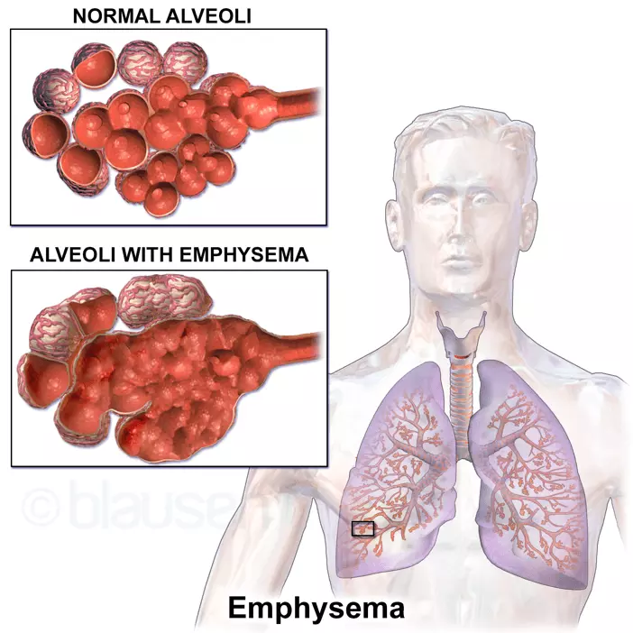 The Effect of Emphysema on the Alveoli SimpleMed The Effect of Emphysema on the Alveoli SimpleMed