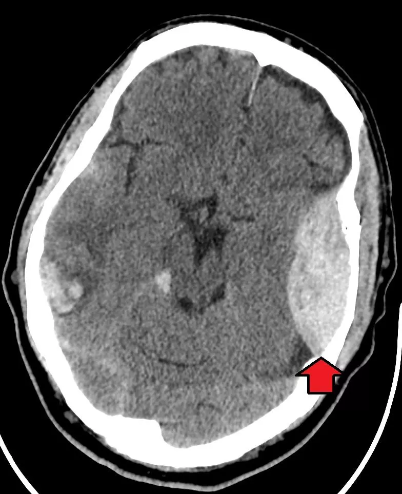 Extradual Haemorrhage CT Scan SimpleMed Extradual Haemorrhage CT Scan SimpleMed