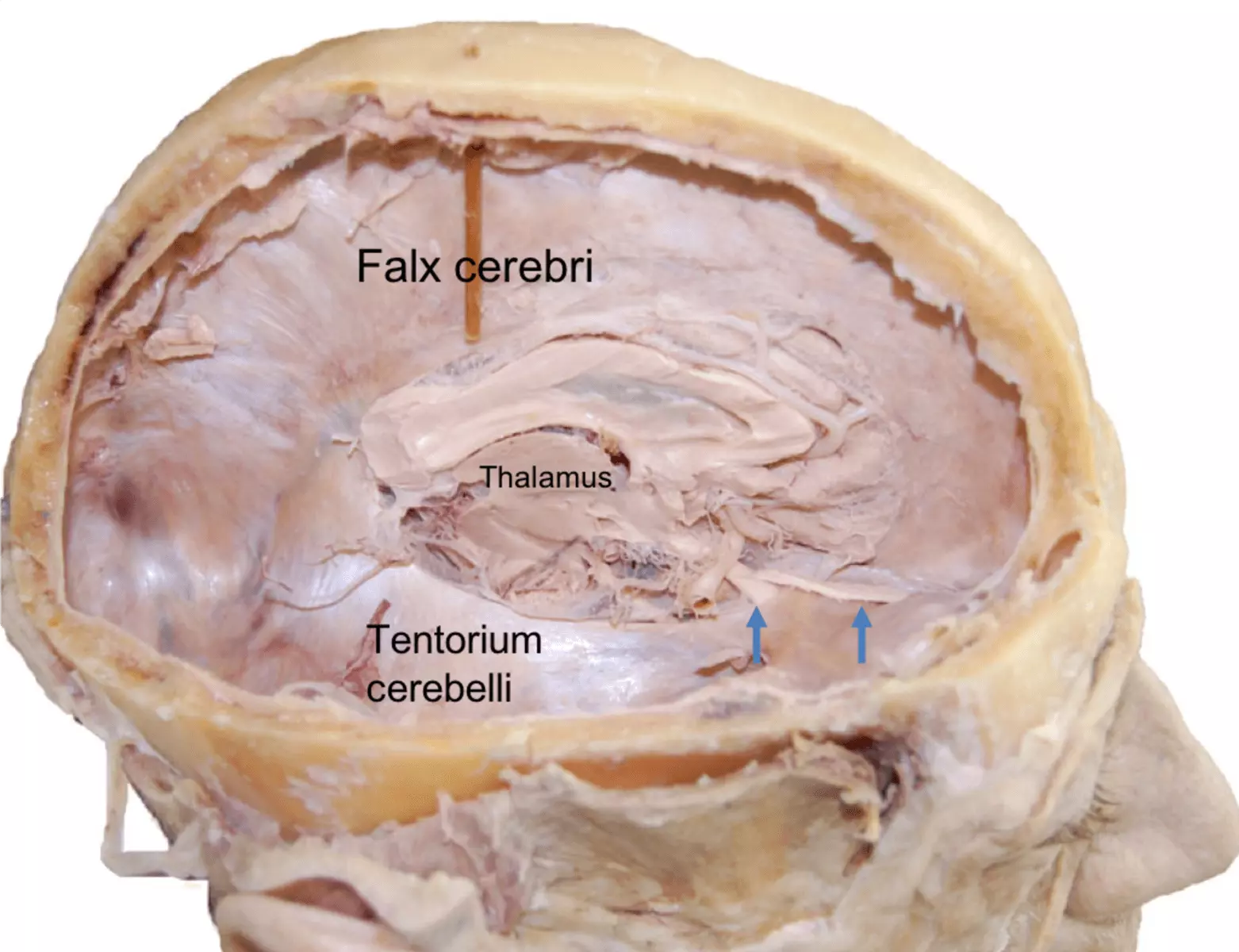 Falx Cerebri and Tentorium Cerebelli Prosection SimpleMed Falx Cerebri and Tentorium Cerebelli Prosection SimpleMed