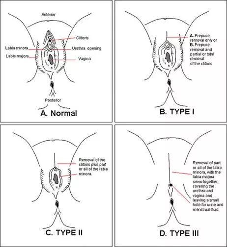 Female Genital Mutilation SimpleMed Female Genital Mutilation SimpleMed