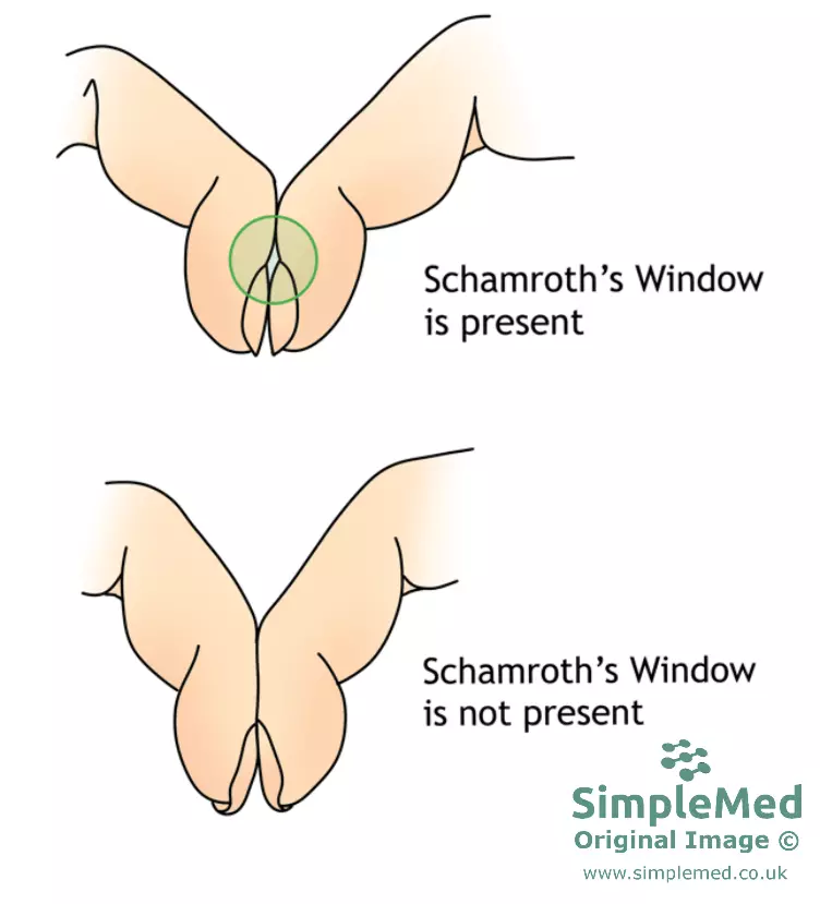Finger Clubbing SimpleMed Finger Clubbing SimpleMed