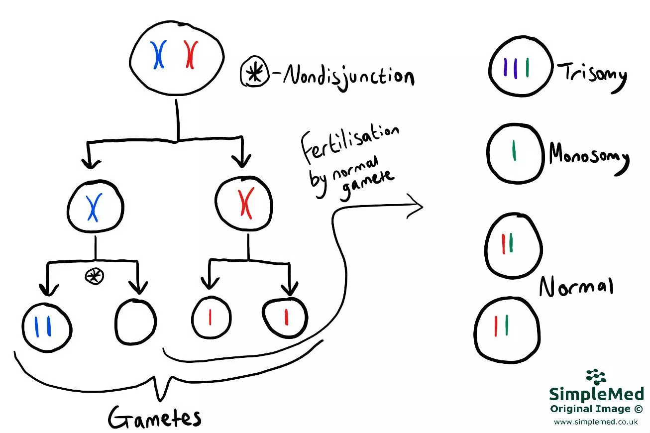 Non-disjunction in Meiosis 2 SimpleMed Non-disjunction in Meiosis 2 SimpleMed