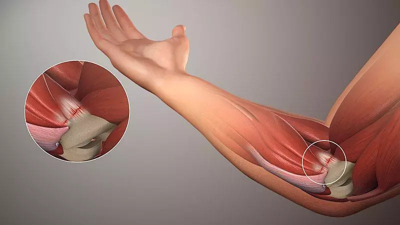 Golfers Elbow/Medial Elbow Tendinopathy SimpleMed