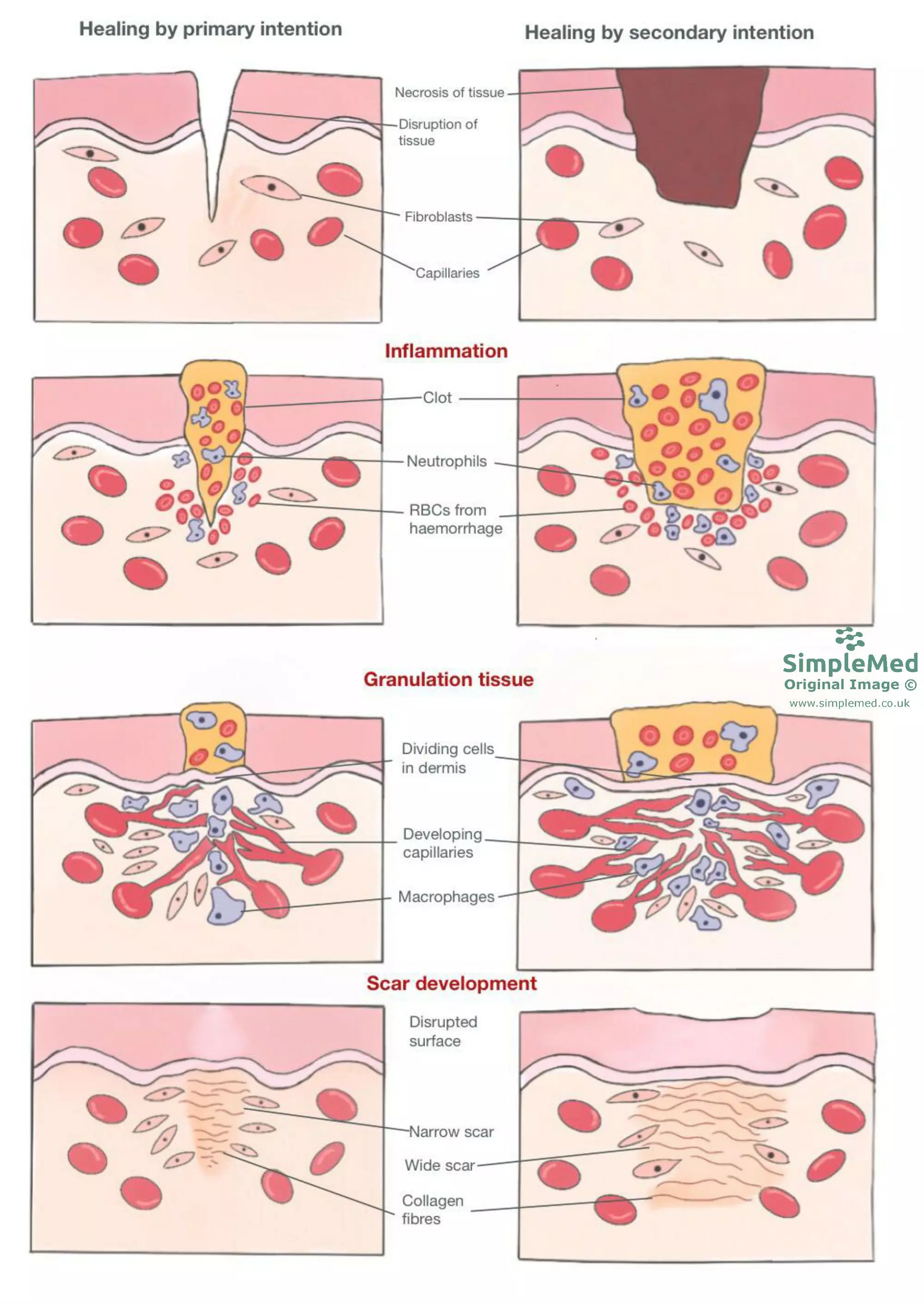 Healing by Primary and Secondary Intention SimpleMed Healing by Primary and Secondary Intention SimpleMed