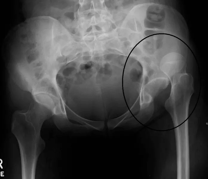 Hip Dislocation X-ray SimpleMed Hip Dislocation X-ray SimpleMed
