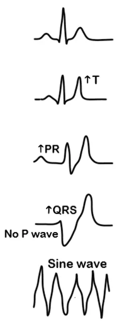 ECG Changes in Hyperkalaemia SimpleMed