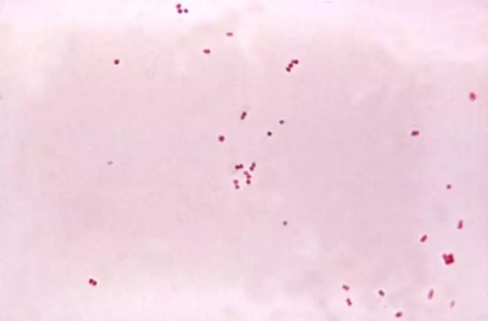 Neisseria Meningitidis Gram Stain SimpleMed Neisseria Meningitidis Gram Stain SimpleMed