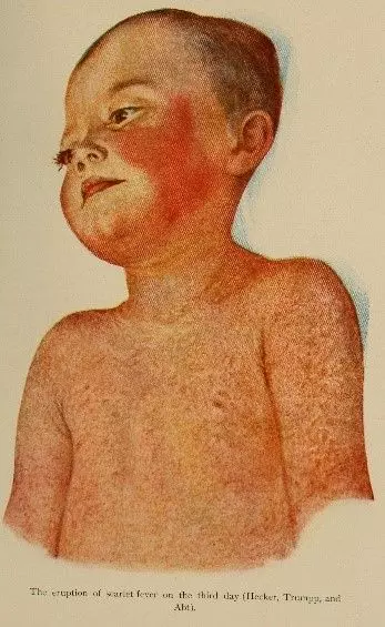 Scarlet Fever SimpleMed Scarlet Fever SimpleMed