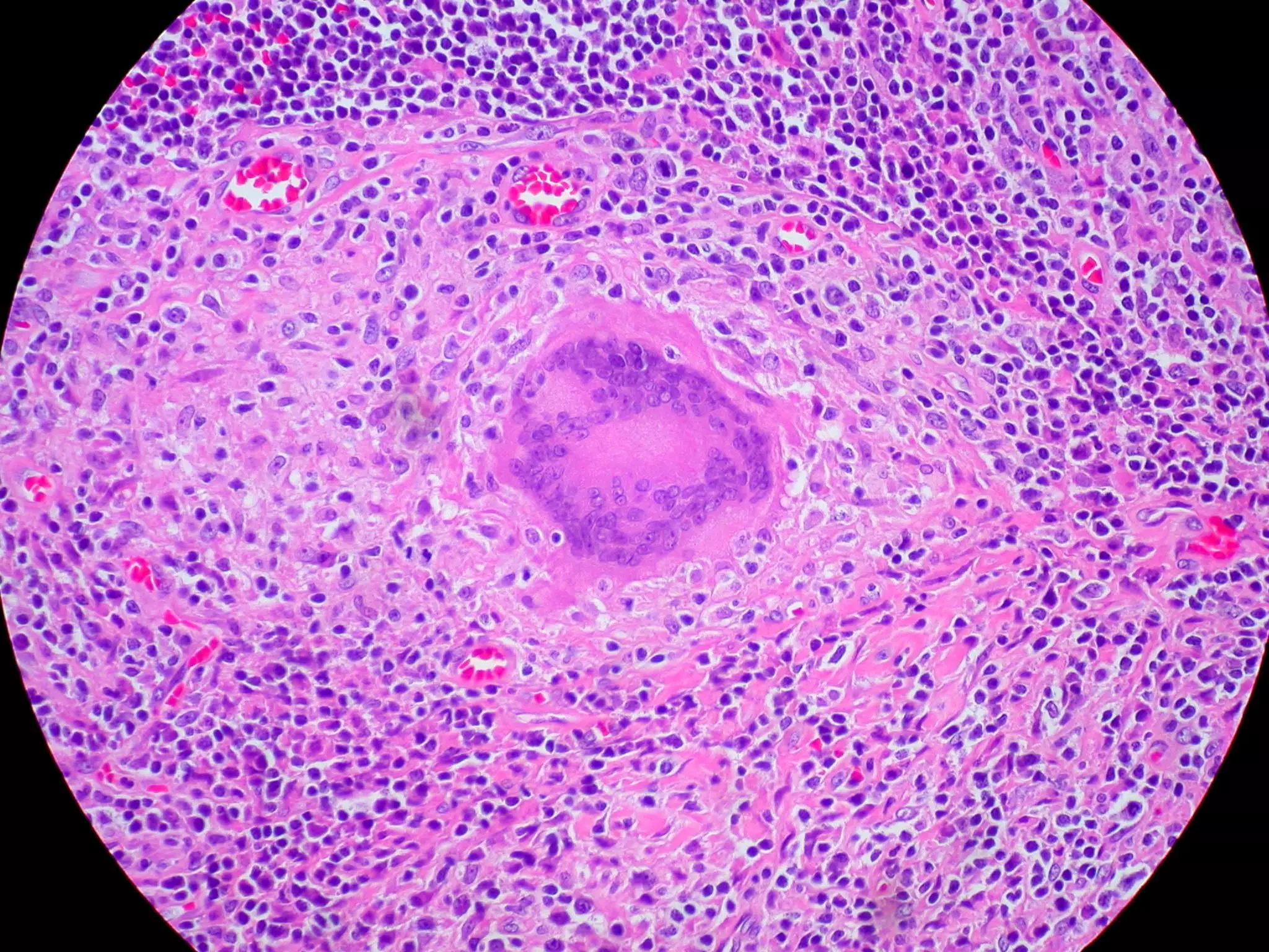 Langhans Giant Cell Histology SimpleMed Langhans Giant Cell Histology SimpleMed