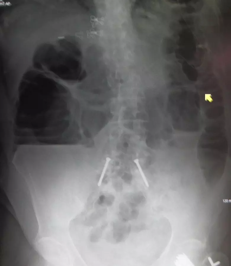 Large Bowel Obstruction Abdominal X-ray SimpleMed Large Bowel Obstruction Abdominal X-ray SimpleMed