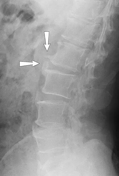 X-ray of Lumbar Spine Spondylosis SimpleMed X-ray of Lumbar Spine Spondylosis SimpleMed