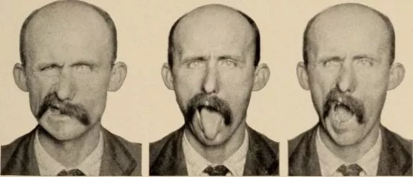 Left Sided Facial Palsy SimpleMed