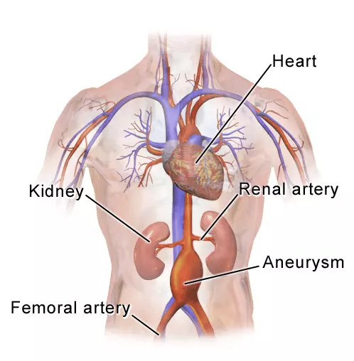 Location of Abdominal Aortic Aneurysm SimpleMed Location of Abdominal Aortic Aneurysm SimpleMed