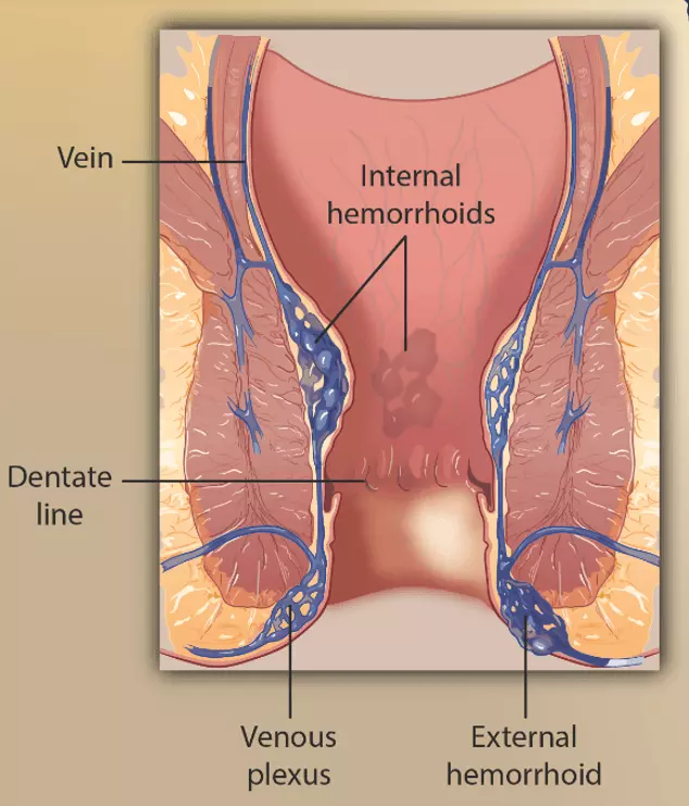 Locations of Haemorrhoids SimpleMed Locations of Haemorrhoids SimpleMed