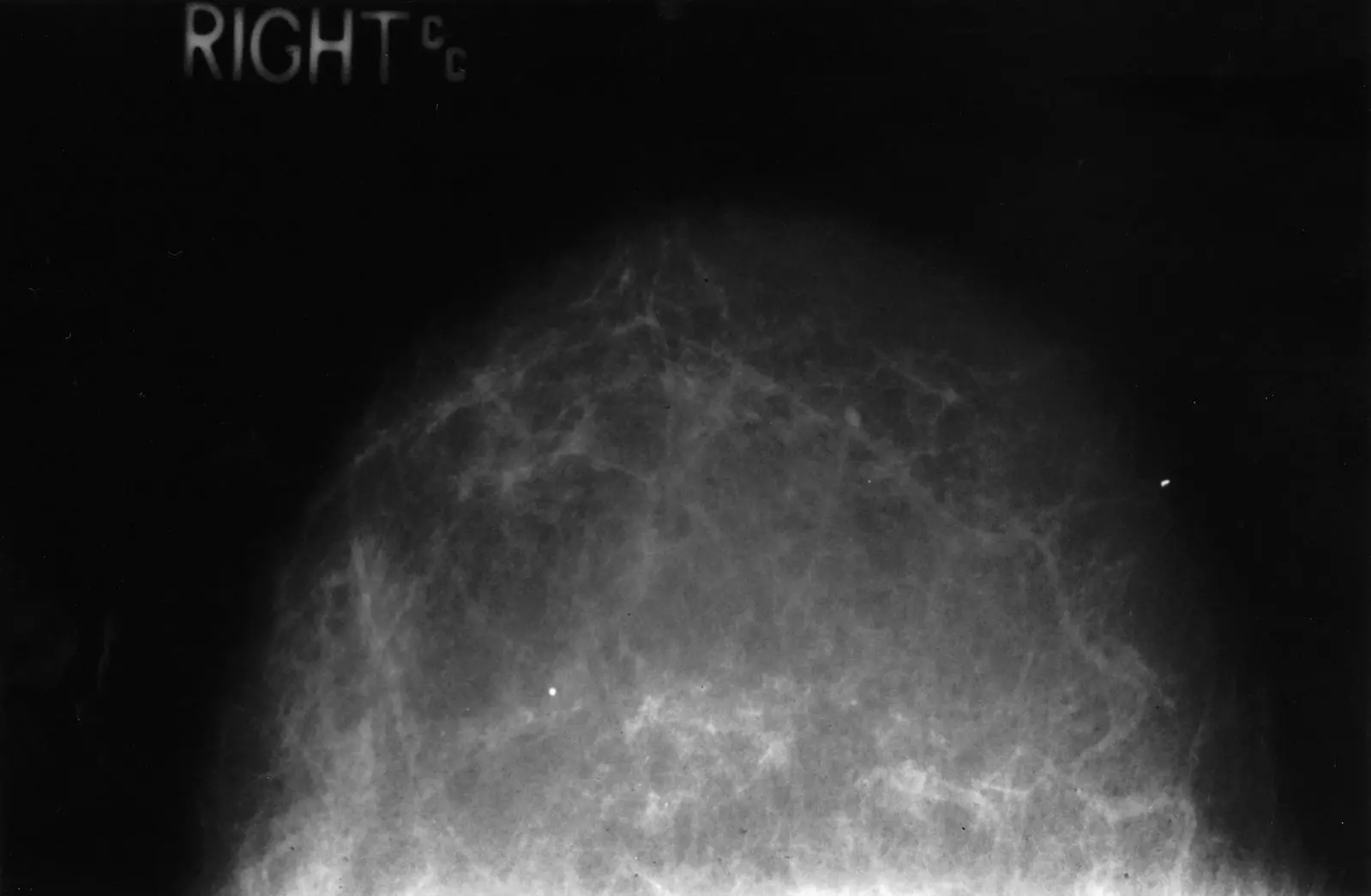 Mammogram of Normal Fatty Breast SimpleMed Mammogram of Normal Fatty Breast SimpleMed