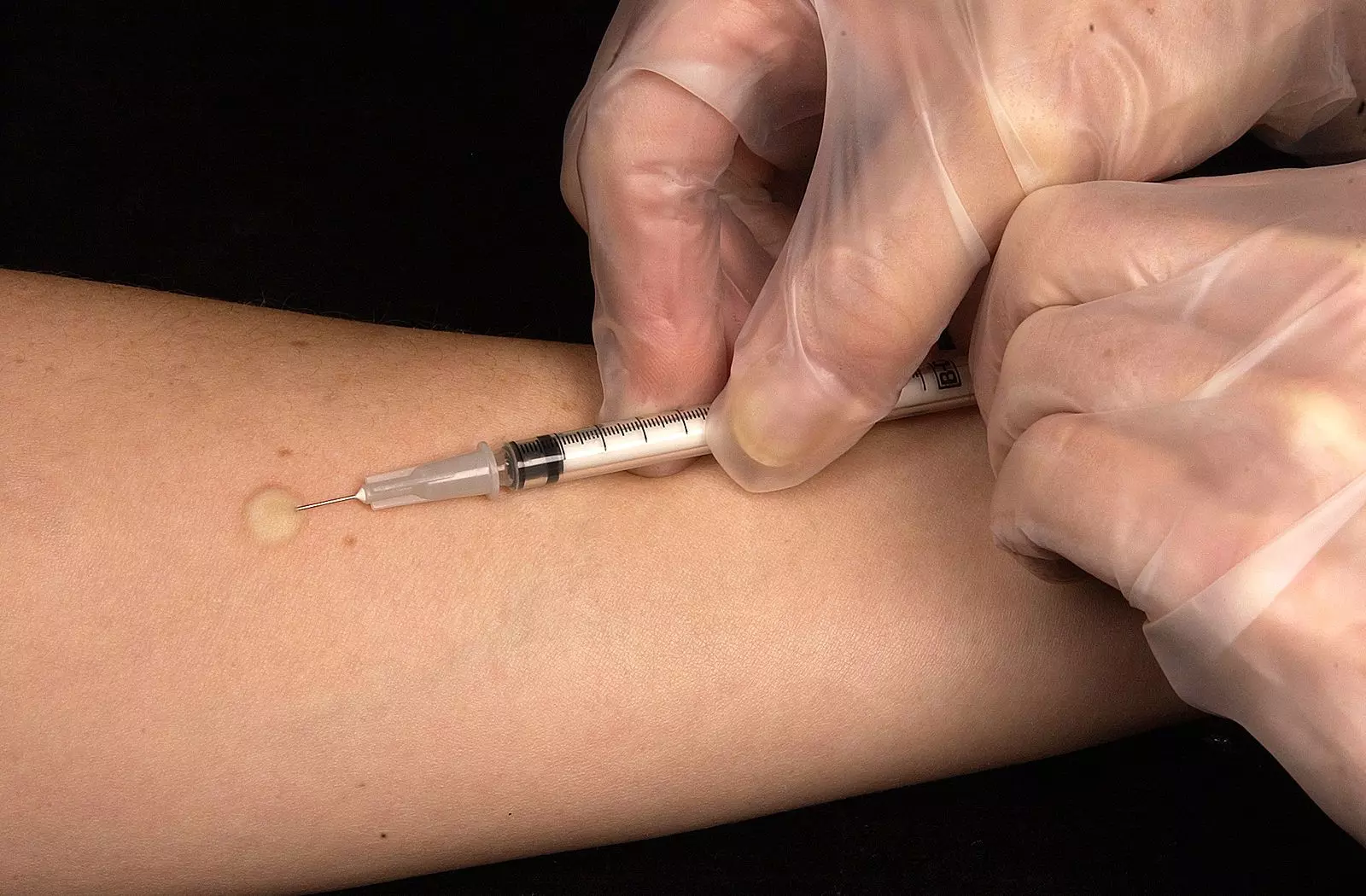 Administration of the Mantoux Tuberculin Skin Test SimpleMed Administration of the Mantoux Tuberculin Skin Test SimpleMed