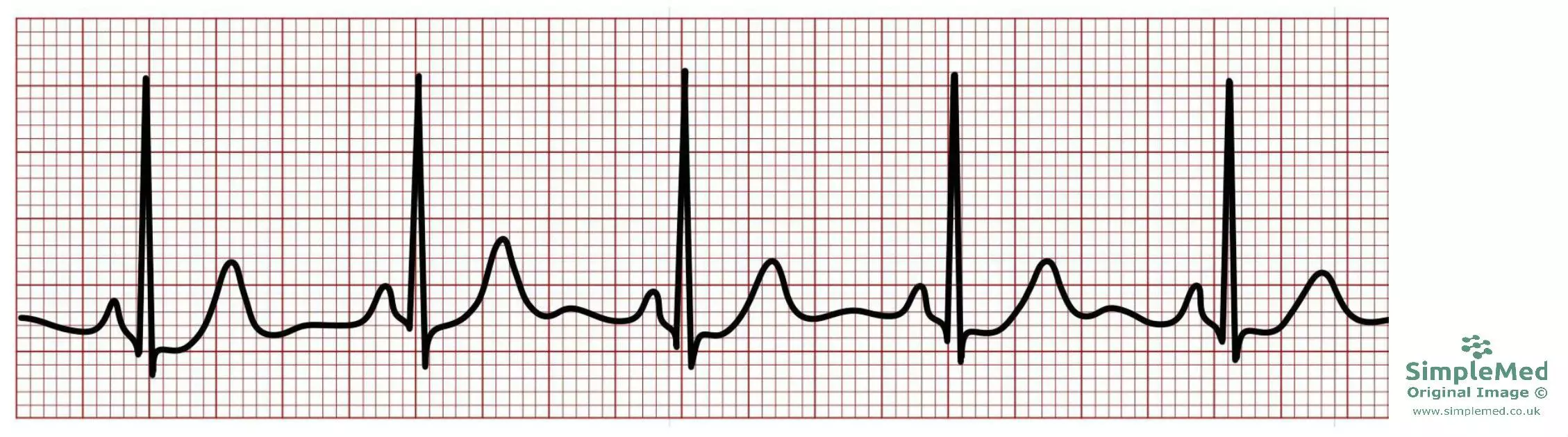 Normal Electrocardiogram ECG SimpleMed Normal Electrocardiogram ECG SimpleMed
