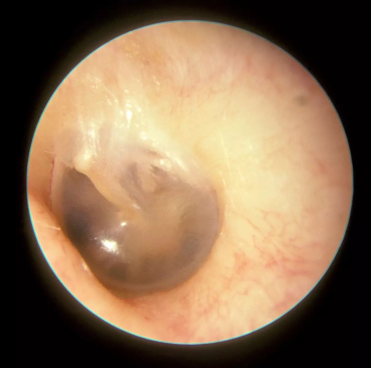Otoscopy of a Normal Left Tympanic Membrane SimpleMed Otoscopy of a Normal Left Tympanic Membrane SimpleMed