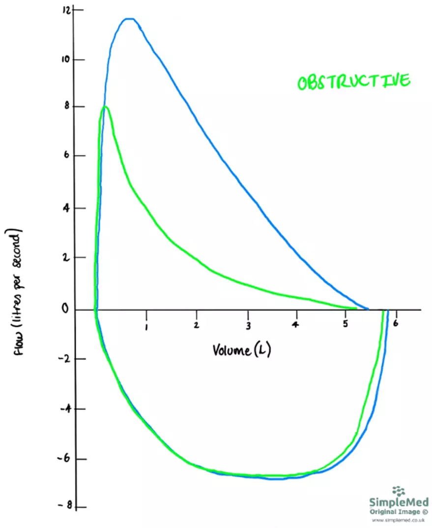 Obstructive Flow Volume Curve SimpleMed Obstructive Flow Volume Curve SimpleMed