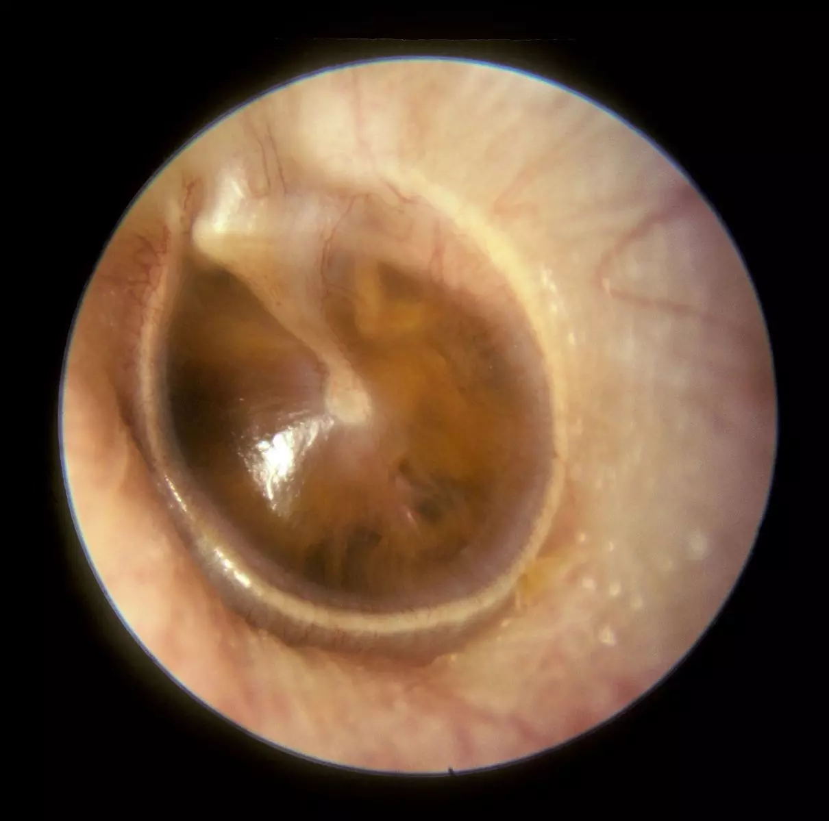 Otitis Media with Effusion SimpleMed