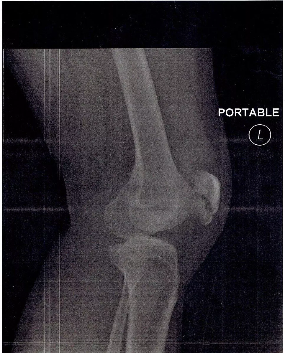 Patella Fracture SimpleMed Patella Fracture SimpleMed